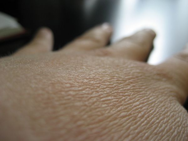 Close-up of dry skin affected by eczema